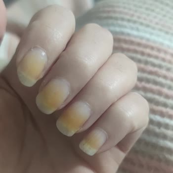 Flormar Oje Kullanımında Uzun Süreli Turuncu Renk Değişikliği Ve Sağlık Endişesi