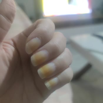 Flormar Oje Kullanımında Uzun Süreli Turuncu Renk Değişikliği Ve Sağlık Endişesi