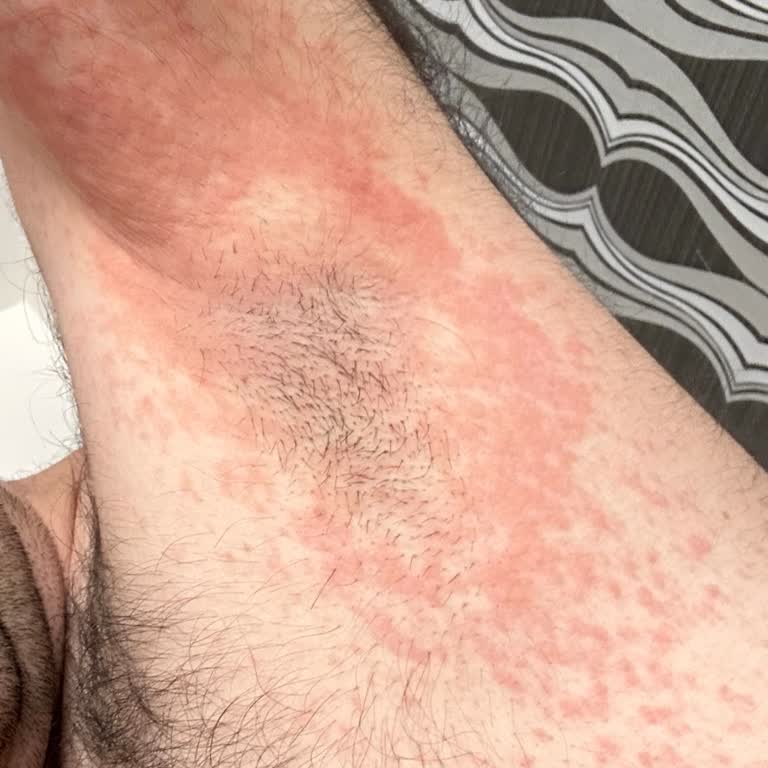 Sebamed Balsam Roll On Hassas Ciltler İçin Alerjik Reaksiyon ve Maddi Telafi Talebi