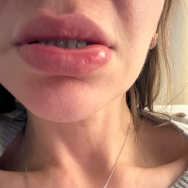 Sensodyne Diş Macununda Şiddetli Alerjik Reaksiyon Ve Telafi Talebi