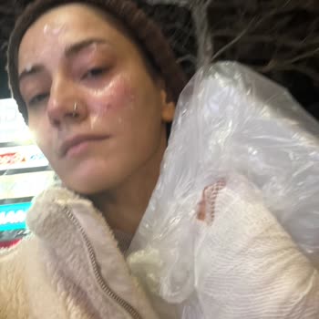 Komili Ayçiçeği Yağının Patlaması Ve Hastane Tedavisi