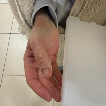 Komili Ayçiçeği Yağının Patlaması Ve Hastane Tedavisi