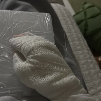 Komili Ayçiçeği Yağının Patlaması Ve Hastane Tedavisi