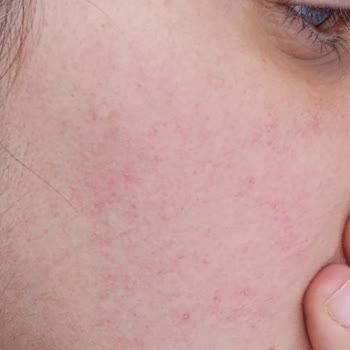 Cilt Reaksiyonu Ve Müşteri Hizmetleri Yanıtı Olmadan Ürün İadesi Talebi