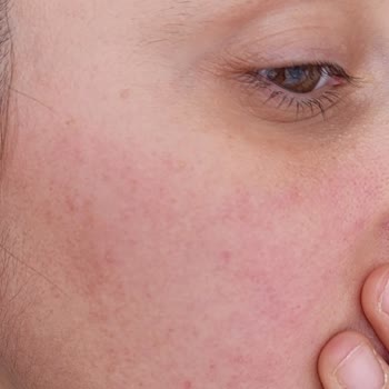 Cilt Reaksiyonu Ve Müşteri Hizmetleri Yanıtı Olmadan Ürün İadesi Talebi