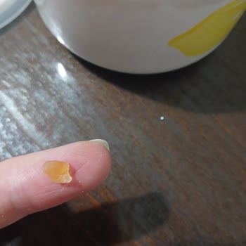 Koska Nazar Boncuklu Lokumda Bulunan Sert Plastik Parça Çocuğumun Dişine Tehdit Oluşturdu