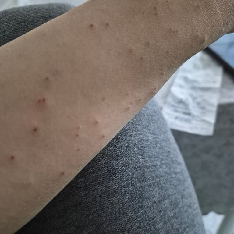 Sağlık Sorunu Nedeniyle Lazer Epilasyon Paketi İptal Edilemiyor, İade Talebi