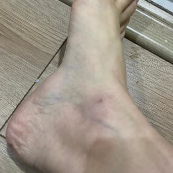 Hoover Kurutma Makinesinde Su Haznesi Düşerek Kırıldı Ve Ayak Bileğinde Yaralanma