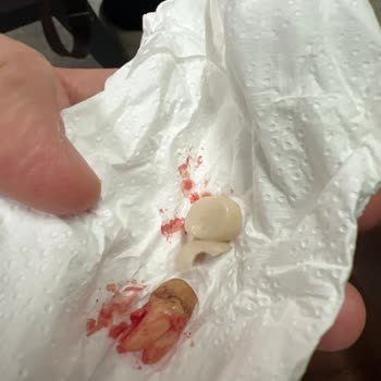 Aydınlatılmış Onam Alınmadan Diş Çekimi Ve Hasta Hakları İhlali