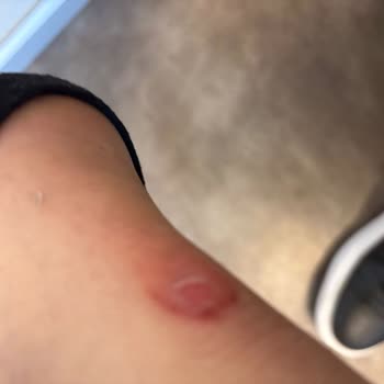 Ayakkabıların Ayağa Zarar Vermesi Ve İade/Değişim Reddi