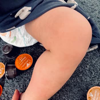 Bebekte Şiddetli Kaşıntı Ve Alerjik Reaksiyon Yaratan Mustela Stelatopia Ürünü