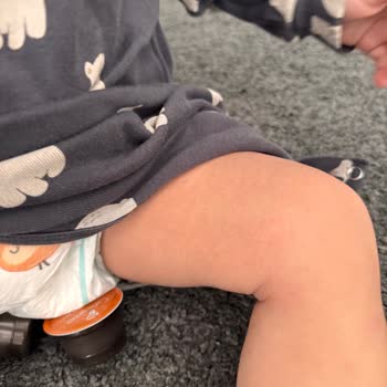 Bebekte Şiddetli Kaşıntı Ve Alerjik Reaksiyon Yaratan Mustela Stelatopia Ürünü