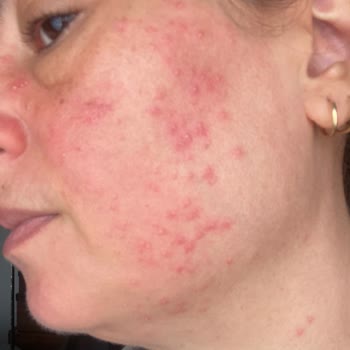 Sinoz Avokadolu Nemlendirici Ve C Vitamin Coctail'de Şiddetli Alerjik Reaksiyon Ve İade Talebi