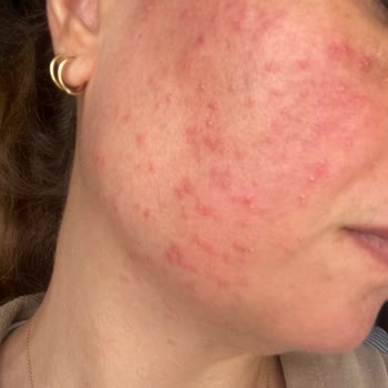 Sinoz Avokadolu Nemlendirici Ve C Vitamin Coctail'de Şiddetli Alerjik Reaksiyon Ve İade Talebi