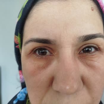 Revitalift Lazer Gece Serumu Göz Altı Morarması Ve Şiddetli Kırışıklık