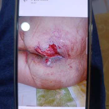 Safranbolu Devlet Hastanesi Annemin Ölümüne Yol Açan Tıbbi İhmal Ve Yanıltıcı Bilgiler