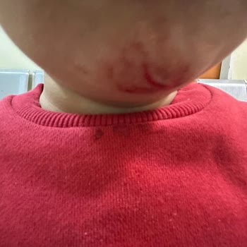 Nestle Gerber Ürünün Yanıltıcı Yaş Bilgisi Çocuğumun Çenesinde Kesik Bıraktı