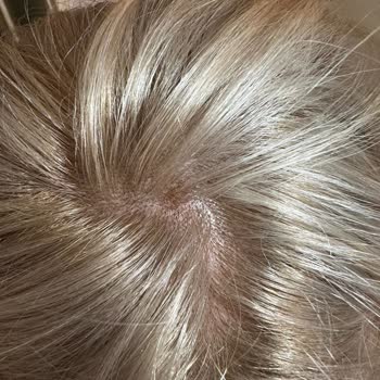 Palette Saç Boyasından Şiddetli Yanma Ve Ağrı: Acı Deneyim