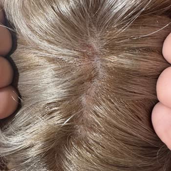 Palette Saç Boyasından Şiddetli Yanma Ve Ağrı: Acı Deneyim