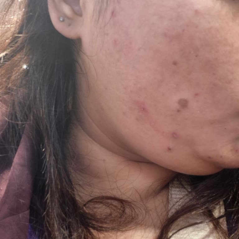 Duaderm Yüzde Şiddetli Yanma Ve Yara Oluşumuna Sebep Oldu, Watsons Mağaza Yardımcı Olmadı