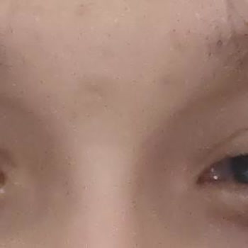 Kalitesiz Lensler Göz Yanması Ve Şişkinliğe Neden Oldu, Firma İletişimsiz