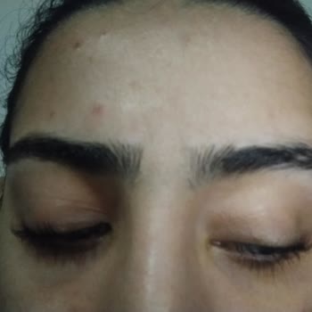 Kirpik Lifting İşlemi Sonrası Kirpiklerim Yanmış Ve Dökülmeye Başladı