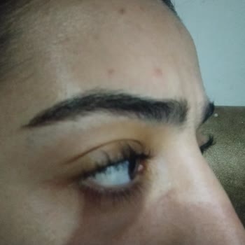 Kirpik Lifting İşlemi Sonrası Kirpiklerim Yanmış Ve Dökülmeye Başladı