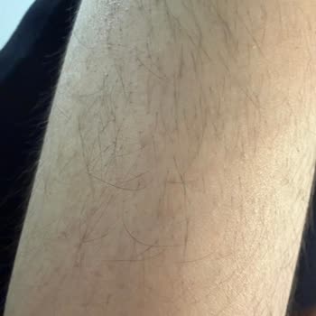 Dr. Well Gaziemir’de Lazer Epilasyon Sonrası Kıllarda Artış Ve 24.000 TL İade Talebi