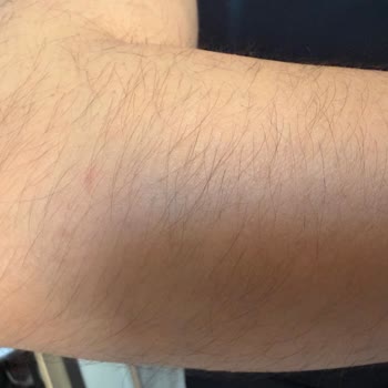 Dr. Well Gaziemir’de Lazer Epilasyon Sonrası Kıllarda Artış Ve 24.000 TL İade Talebi