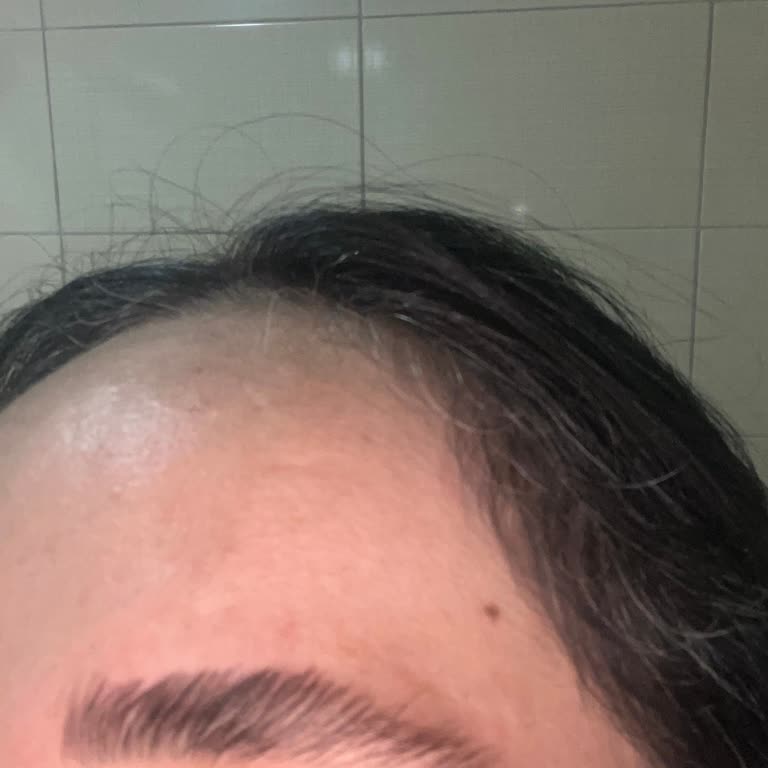 Kaş Laminasyonunda Ölçüm Hatası Ve Saygısız Personel Davranışı