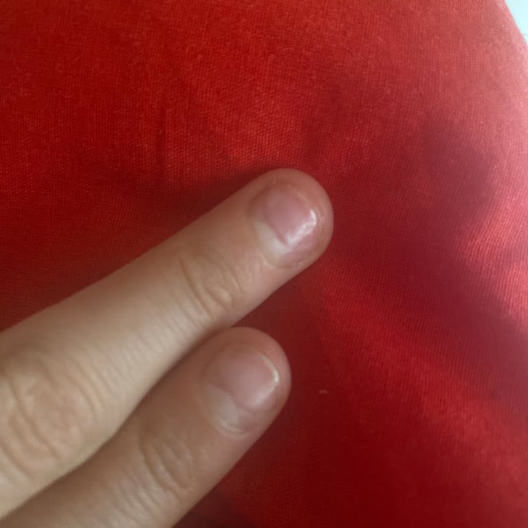 Protez Tırnak Sonrası Tırnakların Kırılması Ve Bilgilendirme Eksikliği