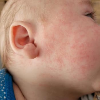 Mustela Stelatopia Ürünü Bebekte Şiddetli Alerjik Reaksiyon Ve Geri Çekilmesi Talebi