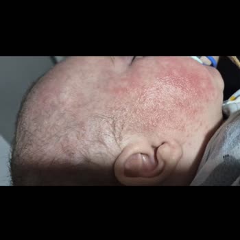 Mustela Stelatopia Ürünü Bebekte Şiddetli Alerjik Reaksiyon Ve Geri Çekilmesi Talebi