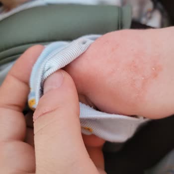 Mustela Stelatopia Ürünü Bebekte Şiddetli Alerjik Reaksiyon Ve Geri Çekilmesi Talebi