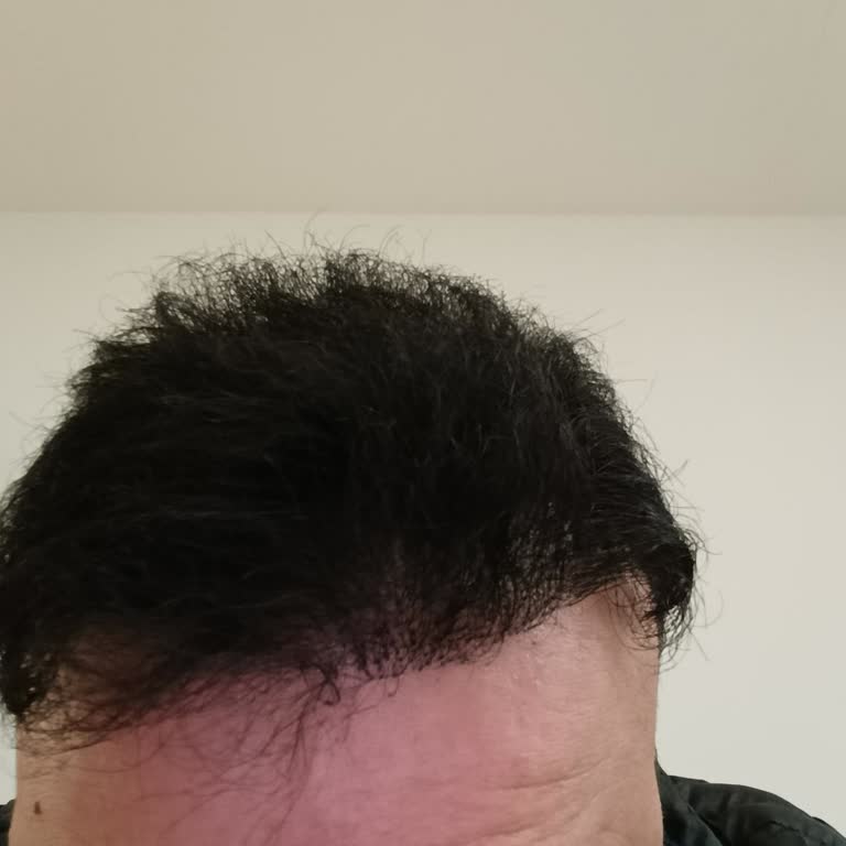 Ninetynine Hair Clinic Saçımı Mahvetti Psikolojimi Bozdu