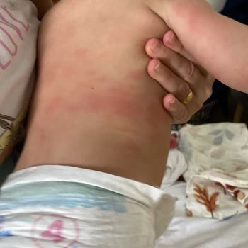 Bebekte Şiddetli Döküntü Ve Kaşıntıya Neden Olan Mustela Stelatopia Ürünleri Geri Çağırılmalı