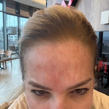 British Esthetic Botoks Sonrası Yüzüm Kızardı ve Uyuştu