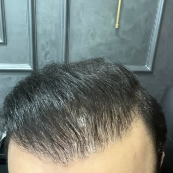 Saç Ekiminden Sonra Sonuçların Kötülenmesi Ve Takip Eksikliği