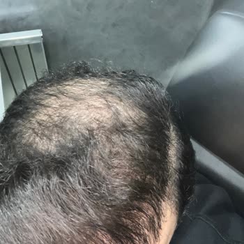 Saç Ekiminden Sonra Sonuçların Kötülenmesi Ve Takip Eksikliği