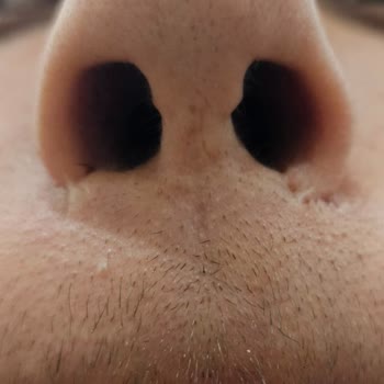 Medical Park Maltepe Hastanesi'nde Burun Estetiği Sonrası Deformasyon Ve Sorumluluk Reddi