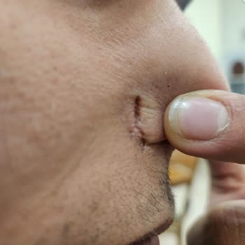 Medical Park Maltepe Hastanesi'nde Burun Estetiği Sonrası Deformasyon Ve Sorumluluk Reddi