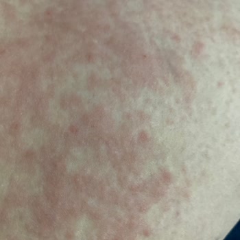 Dalin Bebek Yağında Şiddetli Alerji Ve İade Talebi