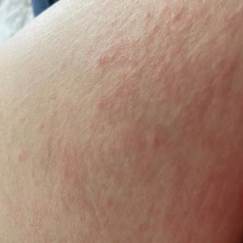 Dalin Bebek Yağında Şiddetli Alerji Ve İade Talebi