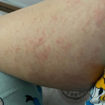 Dalin Bebek Yağında Şiddetli Alerji Ve İade Talebi