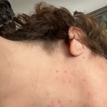 Yves Rocher Şampuan Ve Saç Kreminde Alerjik Reaksiyon Nedeniyle İade Talebi