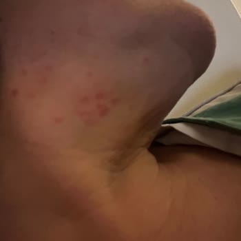 Yves Rocher Şampuan Ve Saç Kreminde Alerjik Reaksiyon Nedeniyle İade Talebi