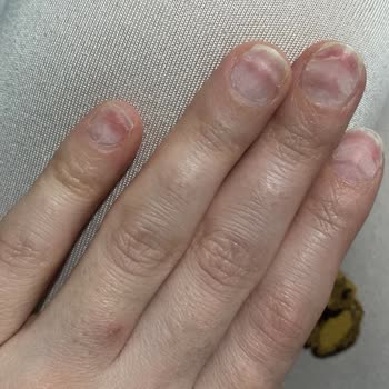 Kontrolsüz Freze Kullanımıyla Protez Tırnak Çıkarma İşlemi Sonrası Ağrı Ve İade Talebi