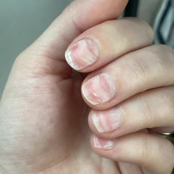 Kontrolsüz Freze Kullanımıyla Protez Tırnak Çıkarma İşlemi Sonrası Ağrı Ve İade Talebi