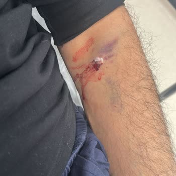 Boyun Bölgesine Aşırı Bası Ve Sevkin Gecikmesi Hastanın Durumunu Ağırlaştırdı