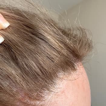 Saç Derisinde Kimyasal Yanık Ve Saç Dökülmesi Nedeniyle 5800 TL İadesi Talebi